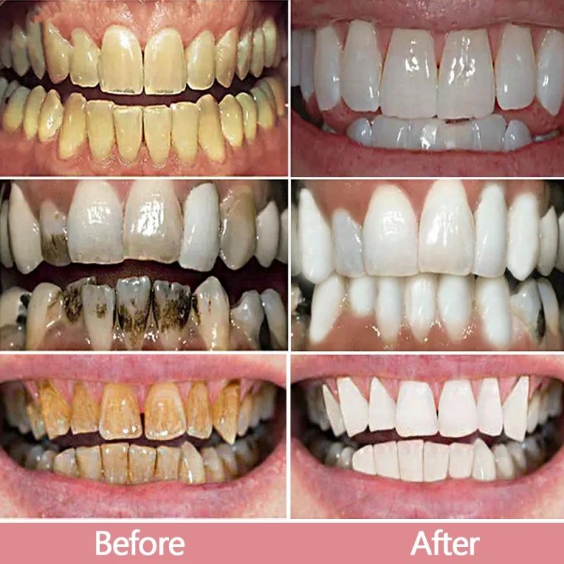 BrightSmile kit [V34]® - Clareamento Dental
